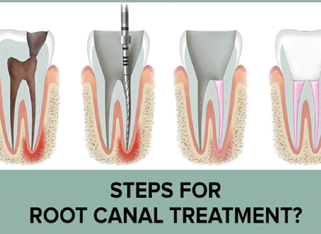 Root Canal Treatment